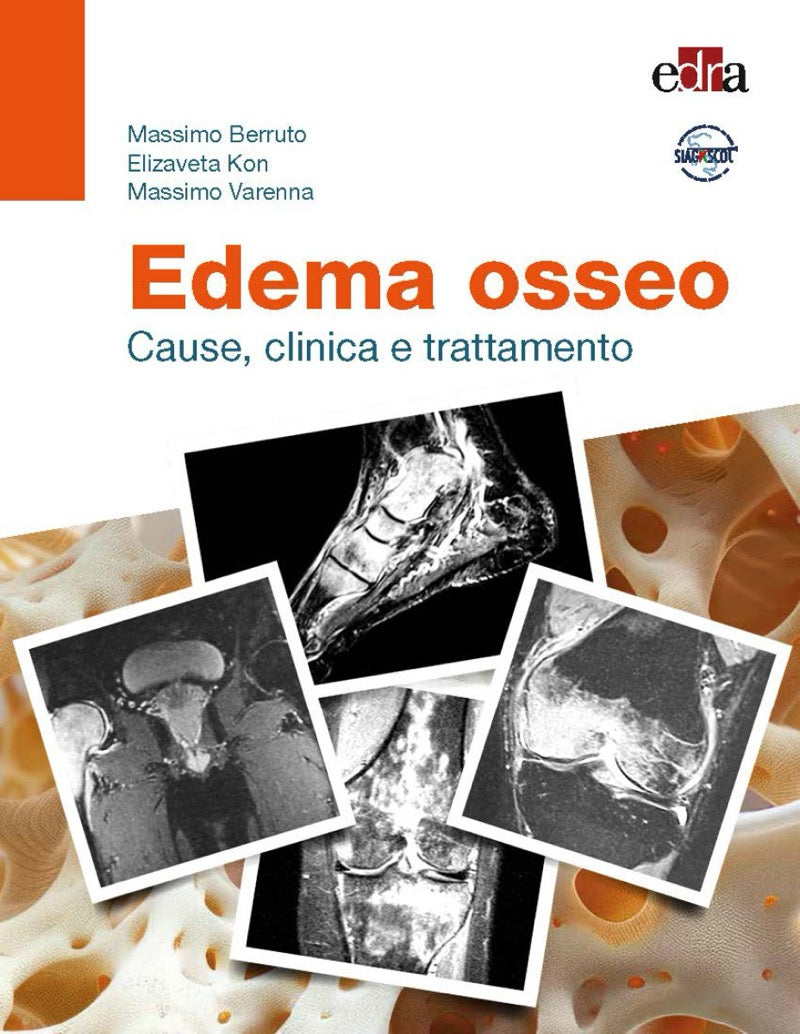 Edema osseo - Cause, clinica e trattamento