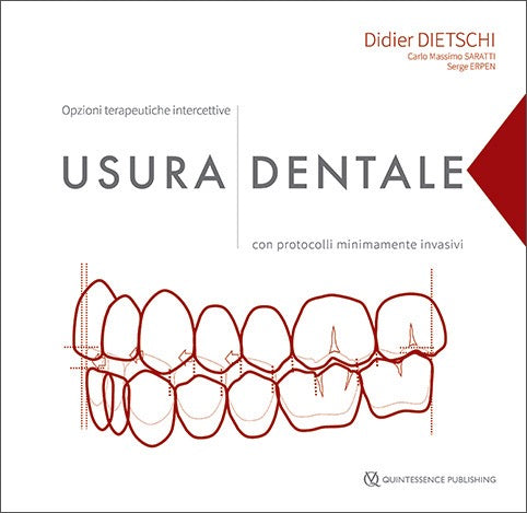 Usura dentale Opzioni terapeutiche intercettive con protocolli minimamente invasivi