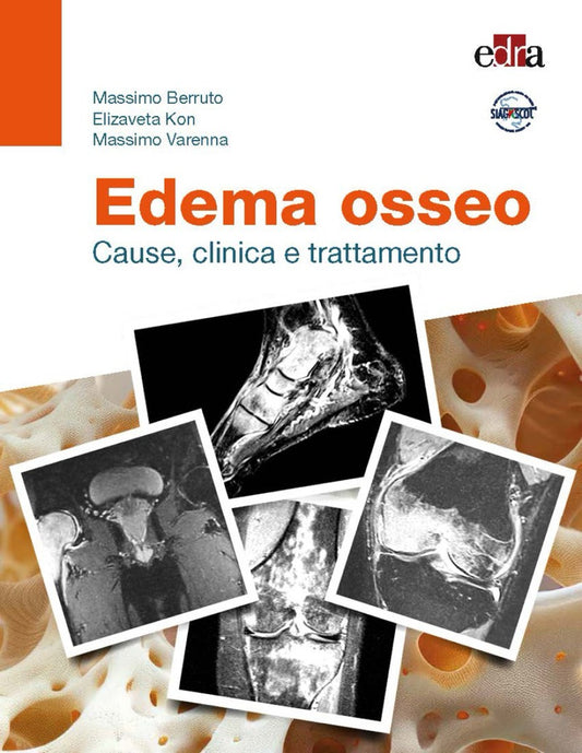 Edema osseo - Cause, clinica e trattamento