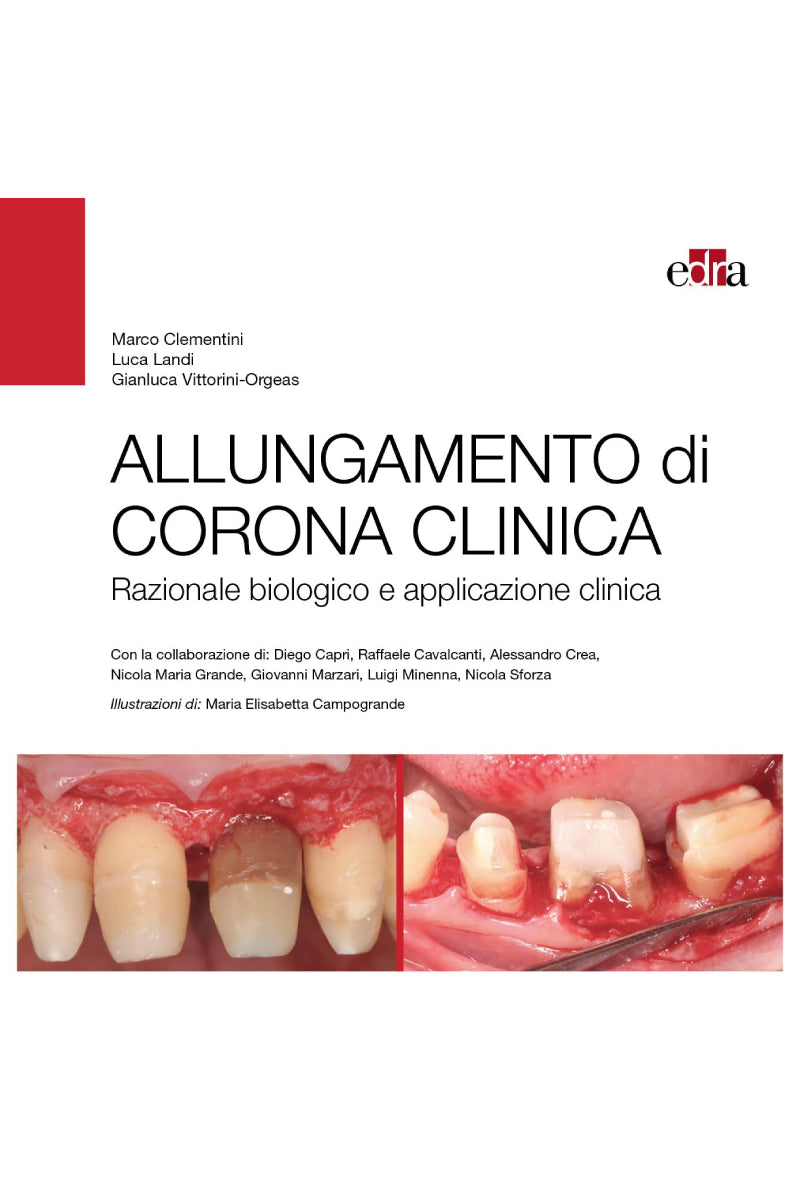 Allungamento di corona clinica - Razionale biologico e applicazione clinica