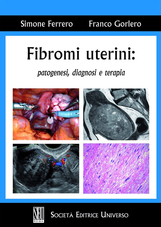 Fibromi uterini : patogenesi , diagnosi e terapia